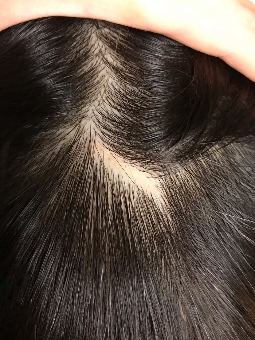 흉터 시술 전
