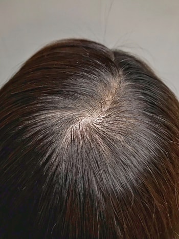 정수리 시술 후