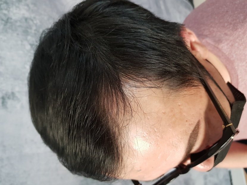 1차 시술후