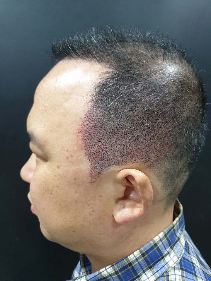 두피문신후 사진