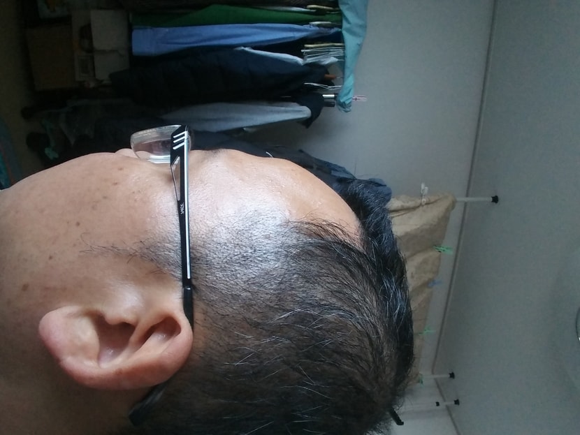 두피문신후 사진(최근)