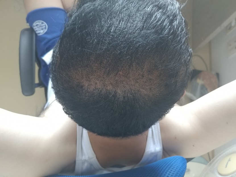 두피문신후 사진