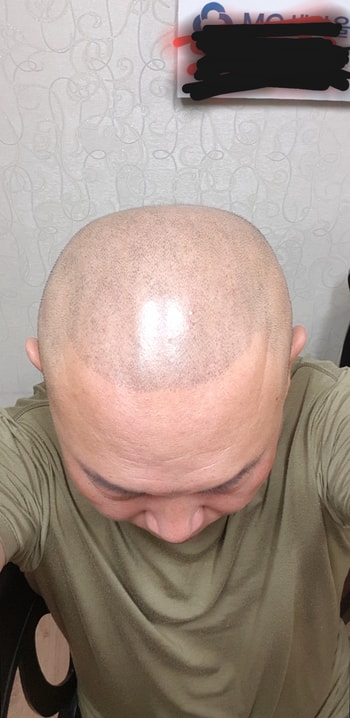 시술한지 한7개월 정도 되었네요~