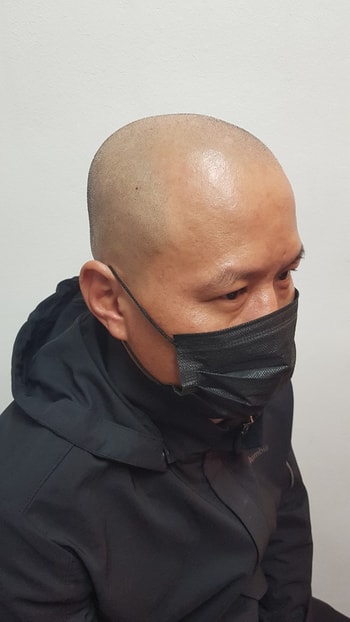 시술전