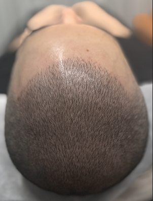 LSMP기법시술사례