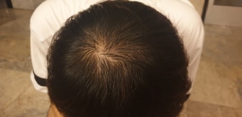 머리 말린 후. 2개월 전에는 정수리만 좀 비었는데 지금은 윗머리가 전체적으로 적어졌습니다