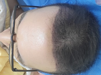 모발이식 후 1일차