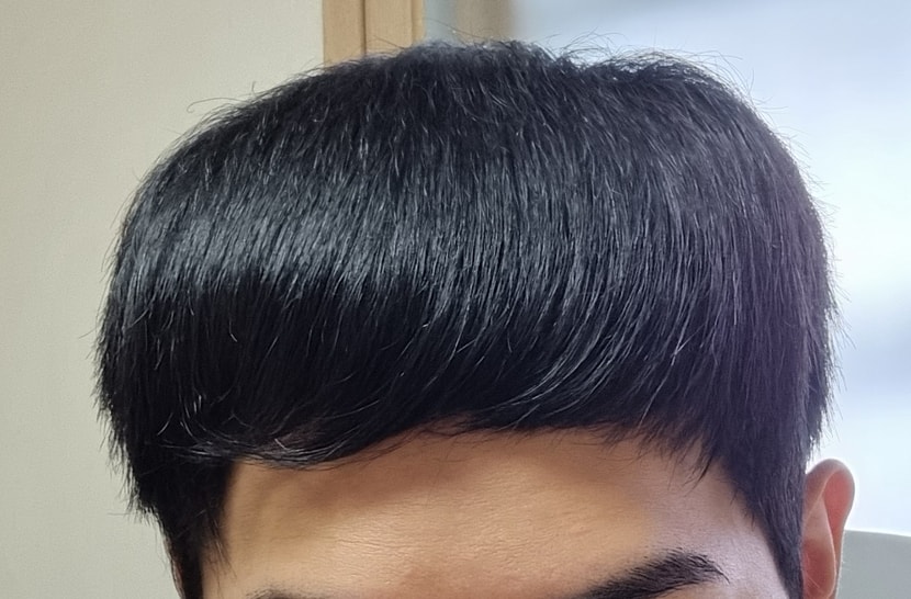 엑소좀 주사를 맞은 이후