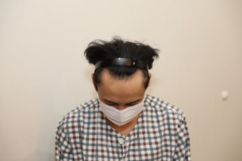 수술 전 M자 탈모(약 4,400모 심음)