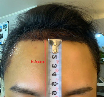 이식 후 이마 6.5-7cm