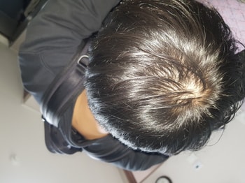 밝았을 때 머리 / 주사(영양제) 맞은 후