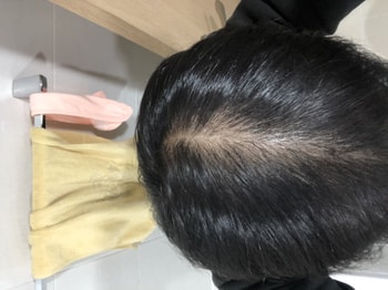 한달 후 가르마 라인