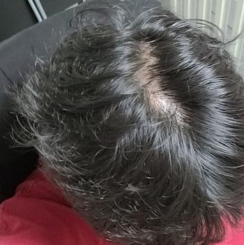 넓어진 가르마와 붉은 두피