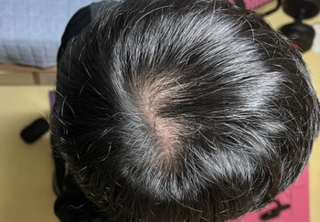 11/18. 형광등 바로 밑에서 직빵으로 맞았을 때ㅠ