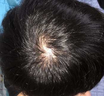 9/15 후레쉬ㅇ - 9월2일부터 쉐딩시작되었고 한창 빠지고있을 때 입니다