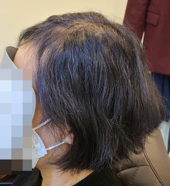 시술 전