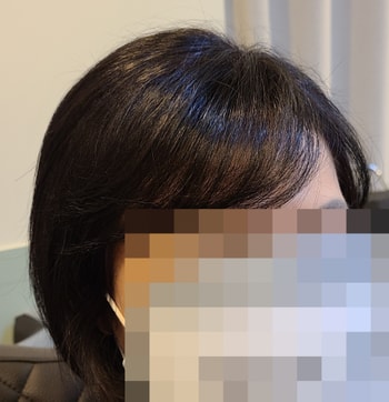 마이크로헤어증모 7000모 시술 후