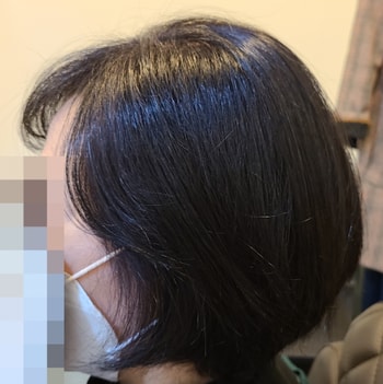 마이크로헤어증모 7000모 시술 후