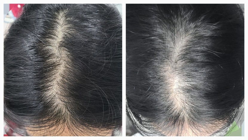 치료 전 후 사진! 아직은 큰 효과는 없는 것 같지만 그래도 잔머리가 솔솔 나오는 것 같기도 하구요 그리고 두피가 점점 깨끗해지는 느낌이 들고 있습니다!
