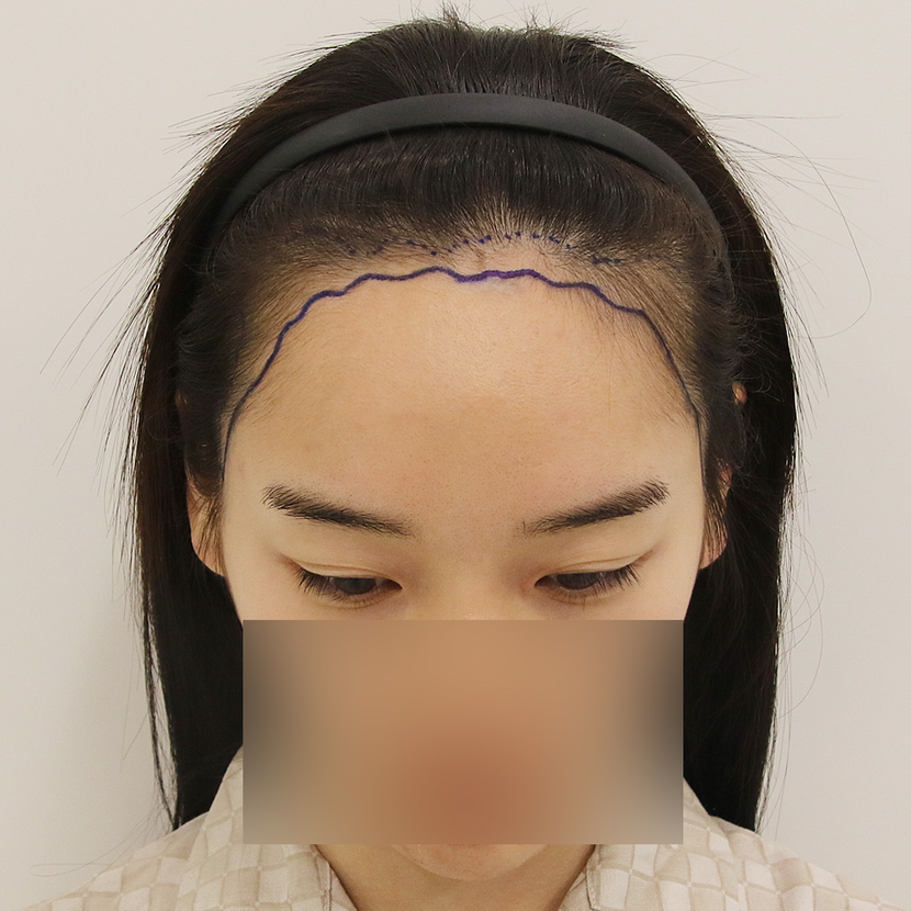 수술 전 디자인 앞
