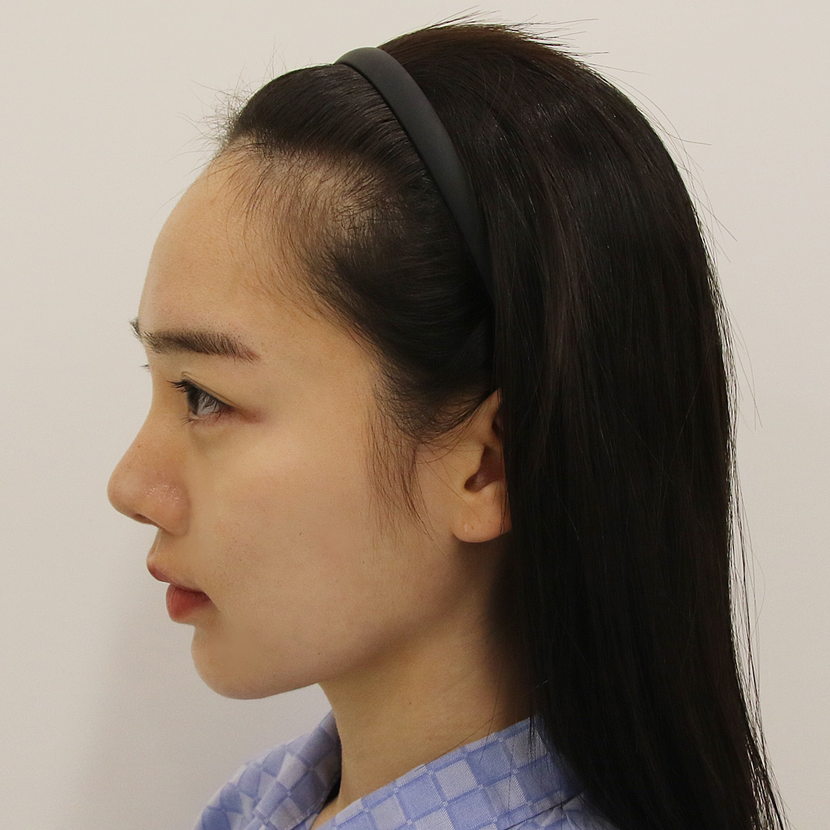 수술전 옆
