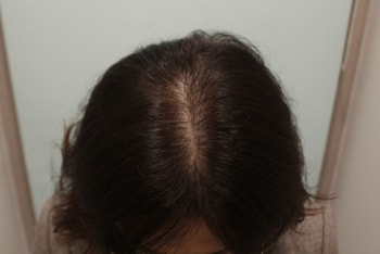 2. 수술 후 반년♥