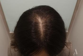 1. 수술 후 반년♥