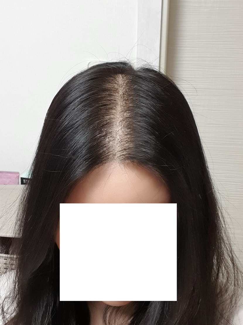 수술 1개월차