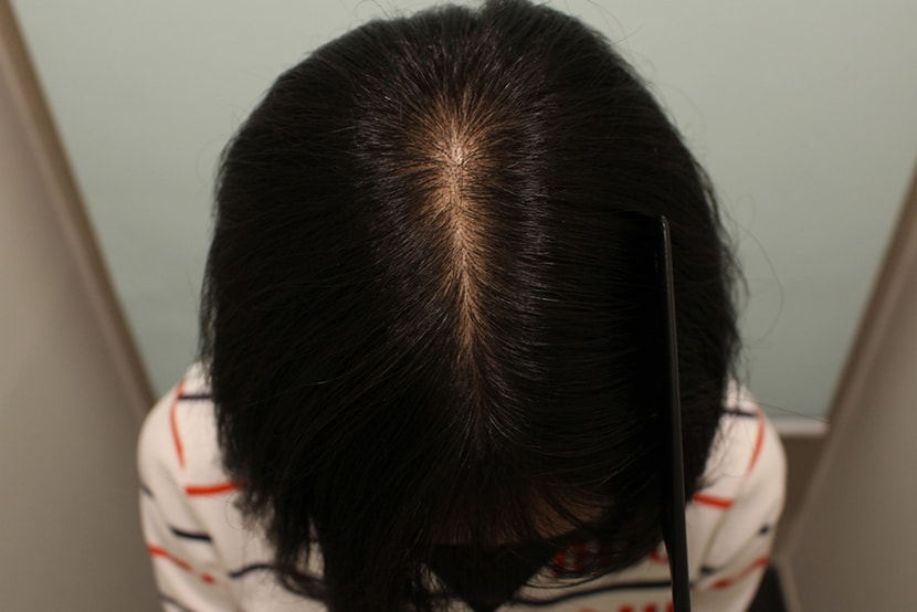 수술 일년반