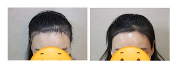 2주차 이마사진